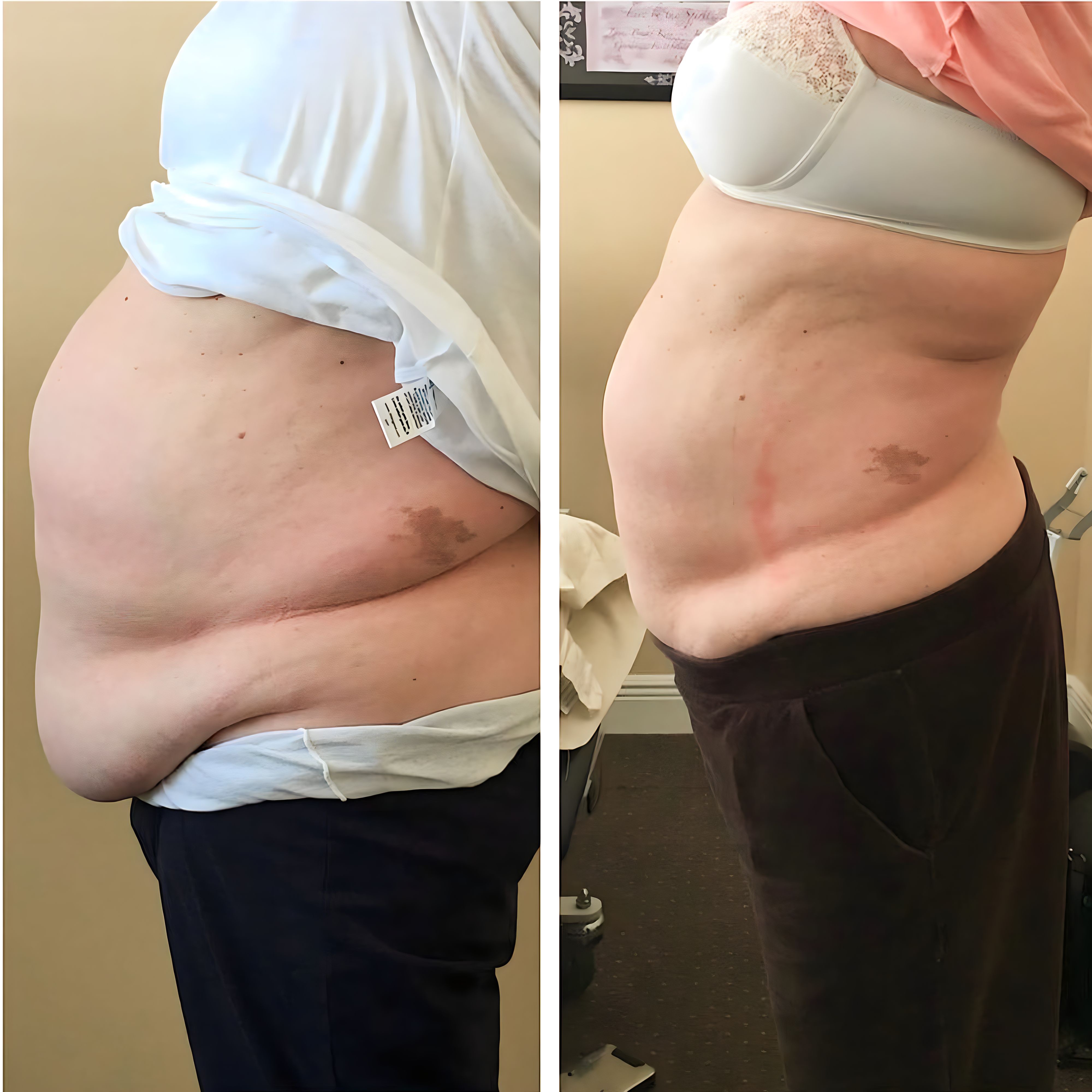 Before and after of significant abdominal reduction.
