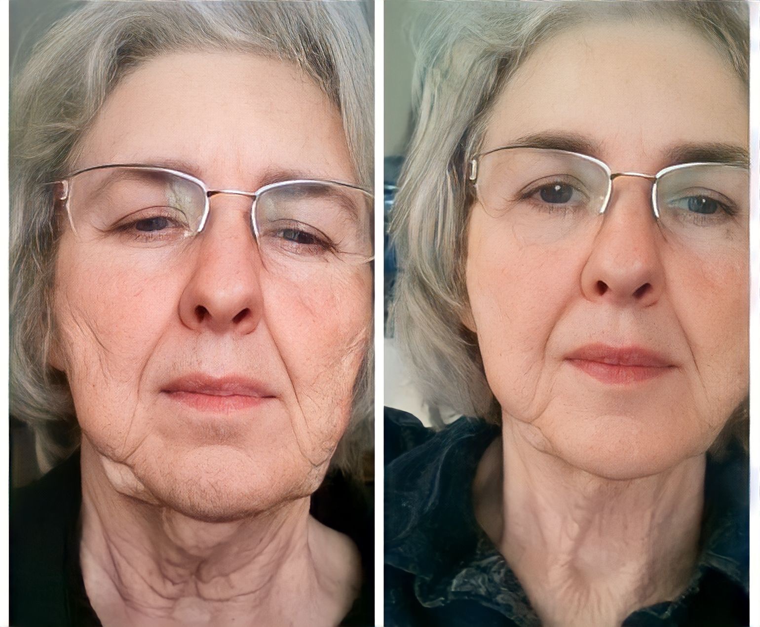 Before and after of a woman's face, showing reduced wrinkles.