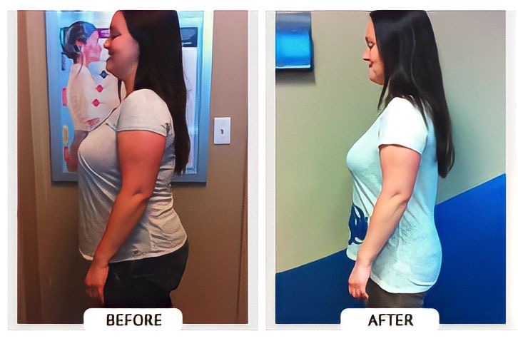 Side profile before and after of a woman.